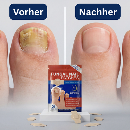 Elevara Patches - die Patches für schönere Fussnägel